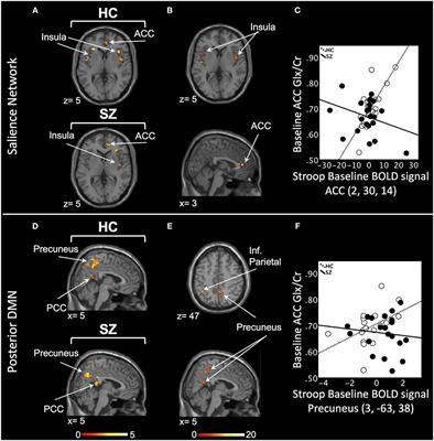 A Longitudinal Multimodal Neuroimaging Study to Examine Relationships Between Resting State Glutamate and Task Related BOLD Response in Schizophrenia